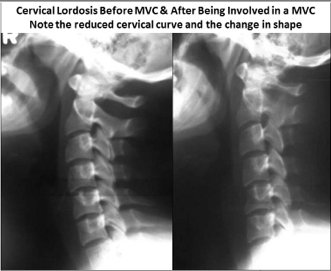 cervical lordosis loss neck curvature car whiplash crash if chiropractor hurt involved help symptoms pain chiropractic injuries re doctor