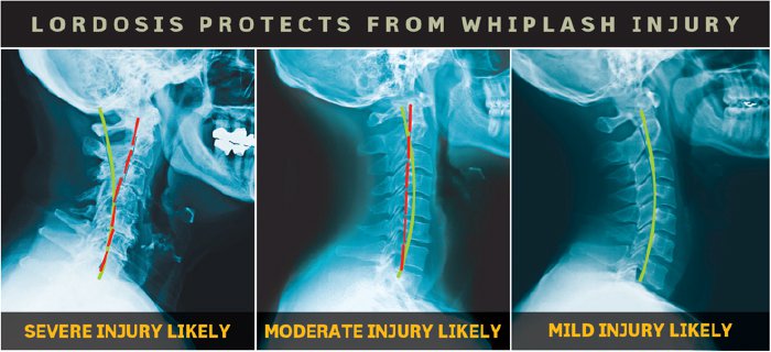 Lordosis Protects from Whiplash