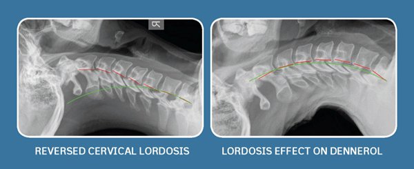Reversed Cervical Lordosis Effect on Denneroll