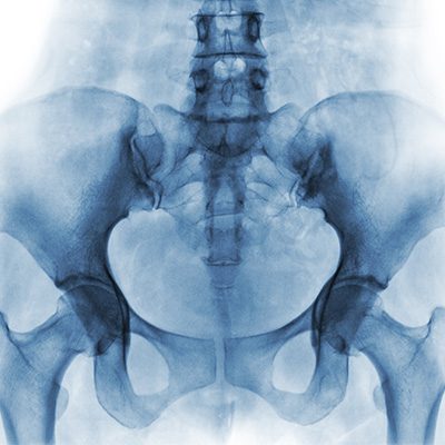 X-Ray of Pelvic Region, Coccydynia Pain - Ideal Spine