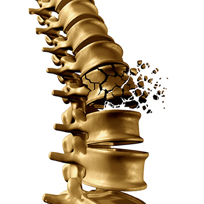 Medical Illustration of a fractured spine