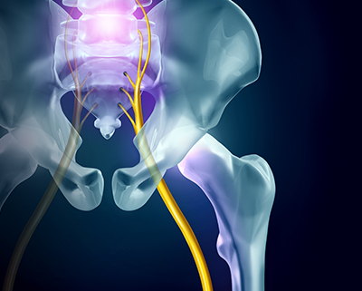 Sacroiliac Joint Dysfunction Or Sciatica Don T Confuse One For The Other Chiropractic Biophysics