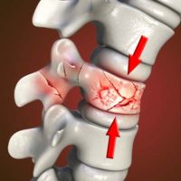 Common Causes of Spinal Damage & Pain