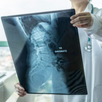 CBP's Role in Alleviating Spinal Stenosis Symptoms