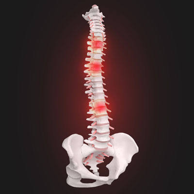 Slow Down Spinal Degeneration