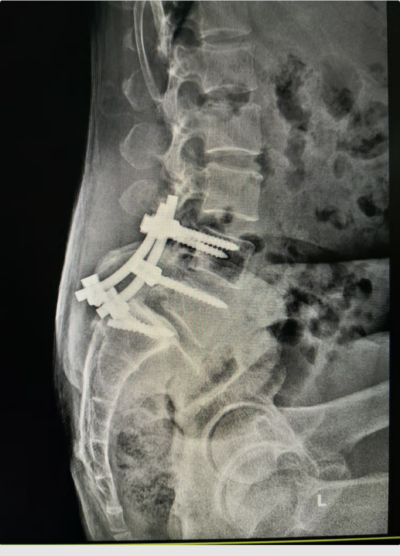 Failed back surgery syndrome and spinal hardware complications